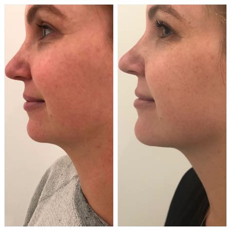 kybella liverpool|Kybella® Overview: Cost, Recovery, Before & After .